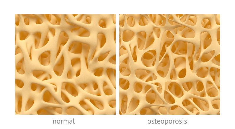 ben med normal struktur och med struktur vid osteoporos